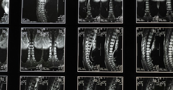 Chiropractic Treatment Helps People Avoid Back Surgery image