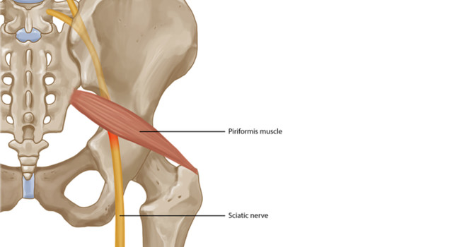 Piriformis Syndrome