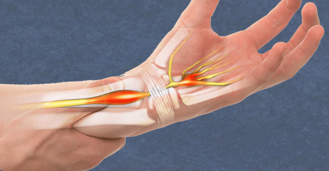 Carpal Tunnel Syndrome